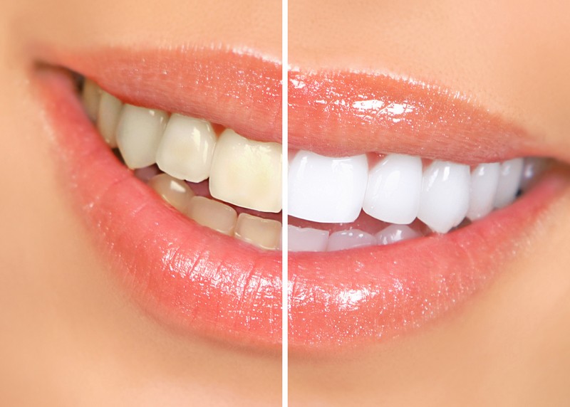 Teeth Whitening  Houston, TX 