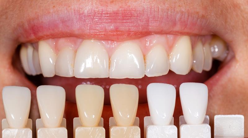 Veneers  Houston, TX 